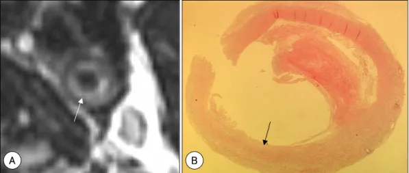 Fig. 2. High-resolution MRI of a hemorrhagic carotid plaque, with an intact fibrous cap