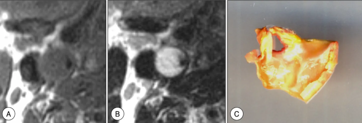 Fig. 5. Gel-like, hydrophilic necrosis of the carotid plaque. A: T1-weighted spin echo image showing a low signal intensity of the plaque.