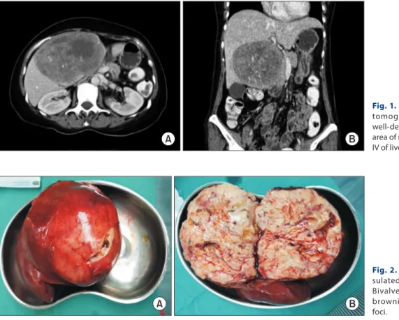 Fig. 1. Axial (A) and coronal (B) computed  tomographyof the abdomen showing a  well-defined predominantly solid mass with  area of necrosis and hemorrhage at segment  IV of liver.