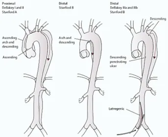 Figure  1.  Anatomical  classification  of  aortic  dissection.  Aortic  dissection described by the DeBakey and Stanford classifications [3].
