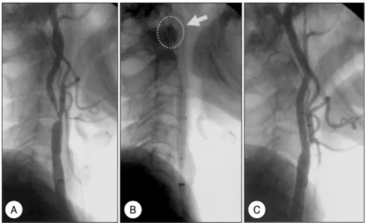 Fig. 4. Placement of self-expandable stent at the internal carotid artery stenosis using PercuSurge GuardWire System