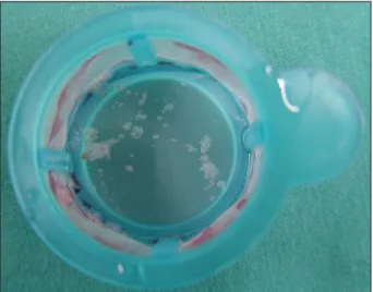 Fig. 6. Plaque debris extracted with PercuSurge Export catheter. 