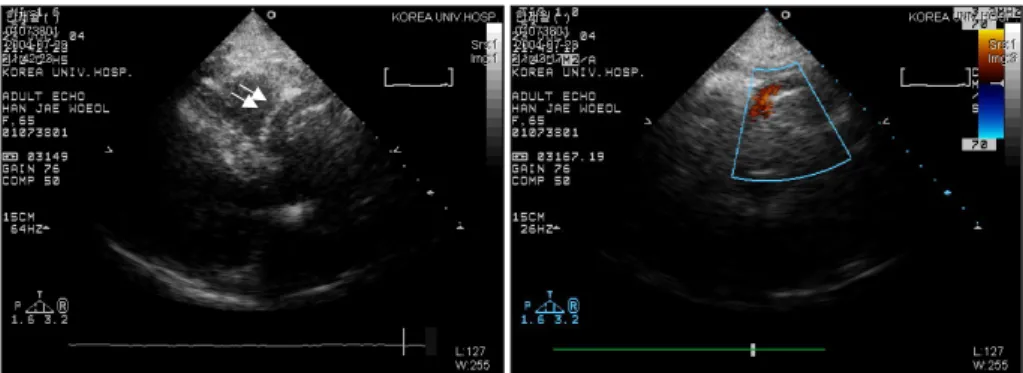 Fig. 1. Modified parasternal long axis view demonstrating a dilated right coronary artery (arrows) from the right coronary cusp of the aorta