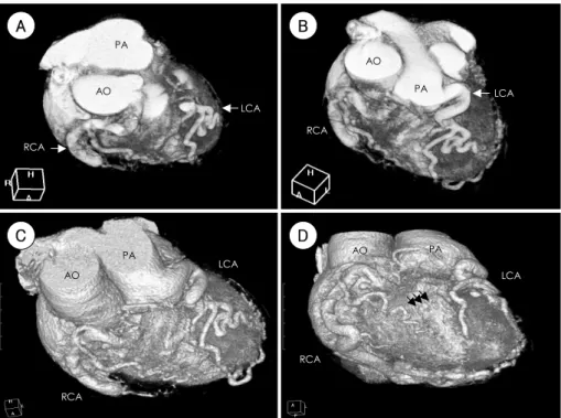Fig. 4. Three-dimensional volumerendered view from the CT coronary angiography enabled the visualization of the dilated RCA from the aorta  (A), anomalous origin of the LCA from PA (B), along with their anatomical relationship with surrounding structures (