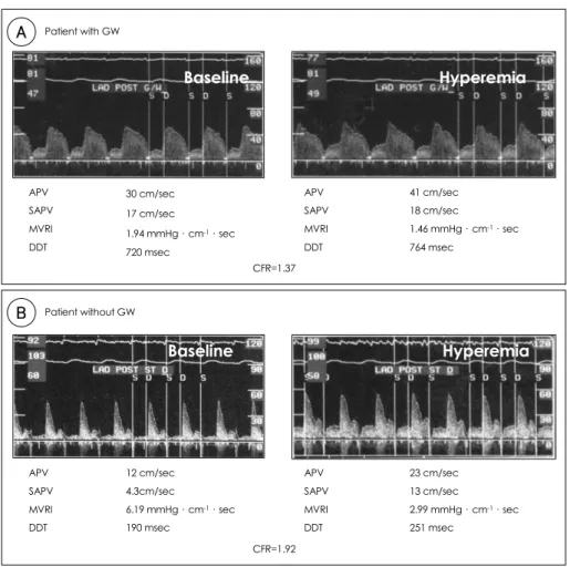 Fig. 4. Phasic coronary flow velocity patterns and CFR in patient with and without a distal protection device (A &amp; B, respectively)