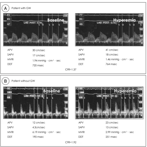 Fig. 4. Phasic coronary flow velocity patterns and CFR in patient with and without a distal protection device (A &amp; B, respectively)