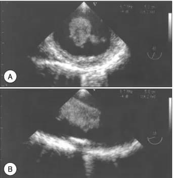 Fig. 2. Chest CT scan demonstrates the thrombus in the aortic arch. CT: computed tomographic