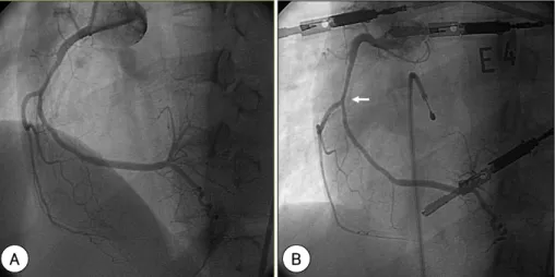 Fig. 1. A: on the left anterior oblique (LAO) view of the right coronary artery (RCA), diffuse and smooth intraluminal narrowing was observed at the mid RCA