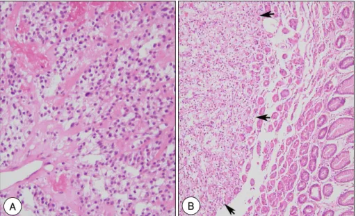 Fig. 5.  A: the renal biopsy shows a clear type renal cell carcinoma (H &amp; E stain,  ×100)