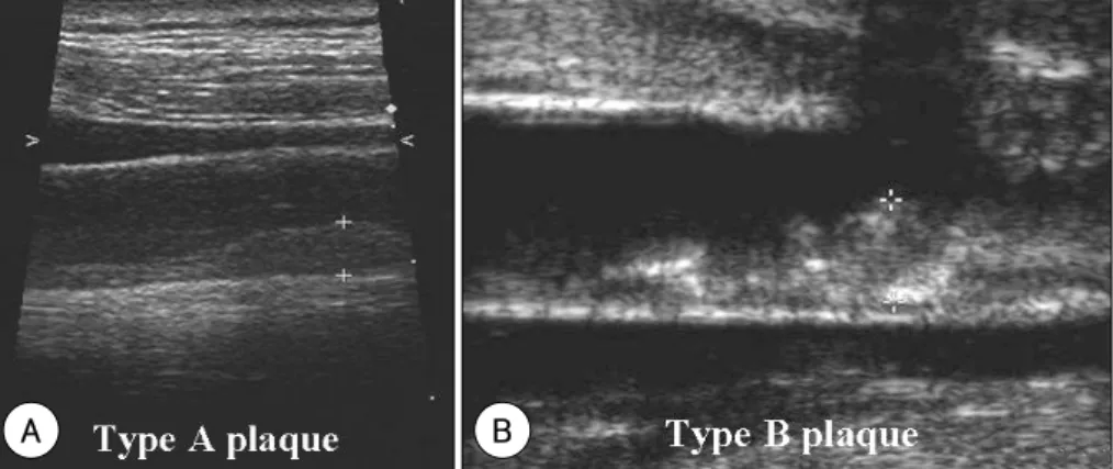 Fig. 1.  Classification of atheromatous plaque. Atheromatous plaque was classied into type A and type B: type A plaque has homogenous low echo- echo-genecity