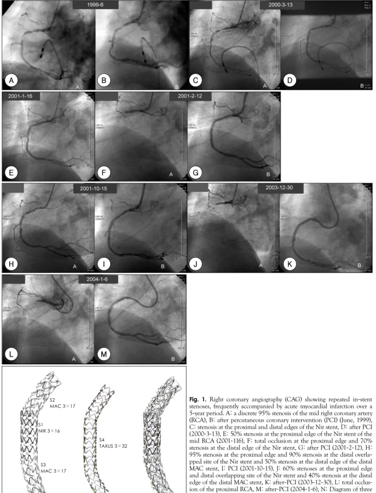 Fig. 1.   Right coronary angiography (CAG) showing repeated in-stent stenoses, frequently accompanied by acute myocardial infarction over a 5-year period