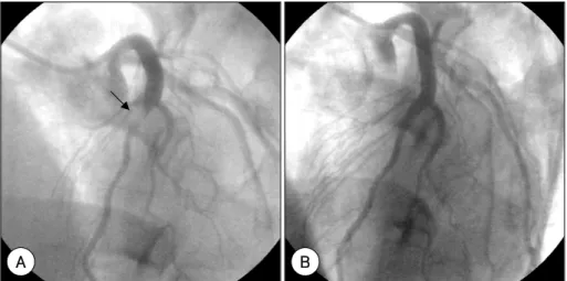 Fig. 1.  Electrocardiography on admission shows regular sinus rhythm and ST segment elevation in precordial leads V1 to V4