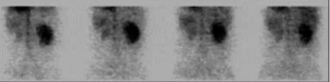 Fig. 5.  Renal scan using  99m Tc-DTPA revealed markedly decreased per- per-fusion into the left kidney and poorly defined nephrogram
