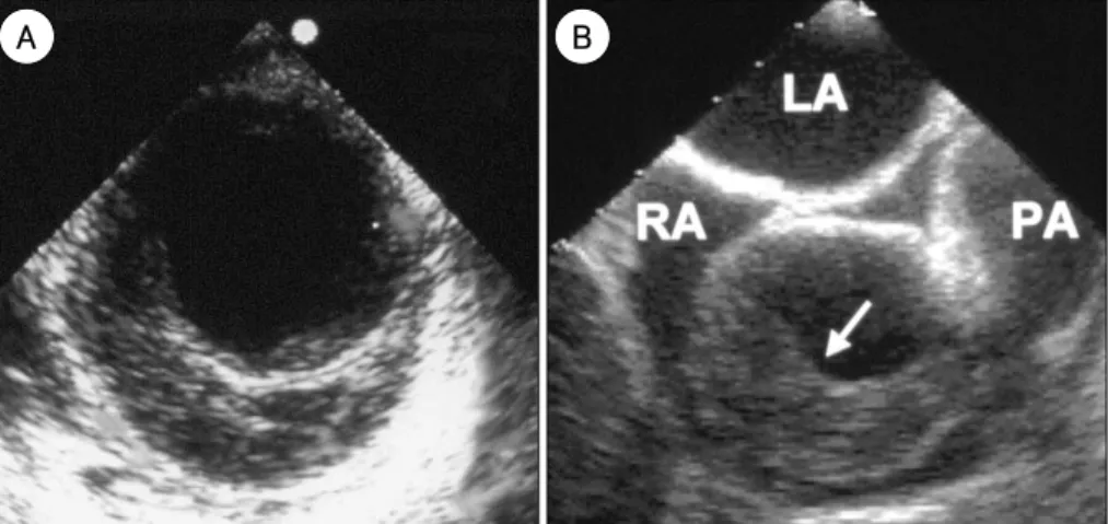 Fig. 4.  Representative transesophageal echocardiographic images of aortic intramural hematoma demonstrating crescentic aortic wall thickening without intimal flap or flow communication in the descending (A) and ascending aorta (B)