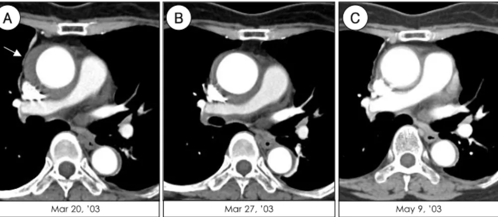 Fig. 6.  A case of aortic intramural hematoma which developed during percutaneous catheter manipulation