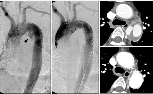 Fig. 13.  A case showing evolution of type B aortic intramural hematoma to localized dissection, in which endovascular treatment was performed.