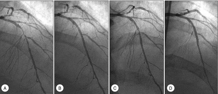 Fig. 1.  Angiography of the left anterior descending coronary artery. A: shows 24 mm long, 89% diameter stenosis with 2.62 mm (2.20 mm) proximal (distal) reference diameter by quantitative coronary angiography