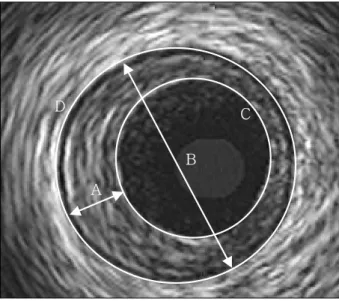 Fig. 1 . Measurement of the carotid intima-media thickness (IMT). The values of the maximal (Max) and mean (Mean) intima-media thickness is automatically calculated using programmed software (M’ATH,  ME-TRIS Co., Argenteuil, France)