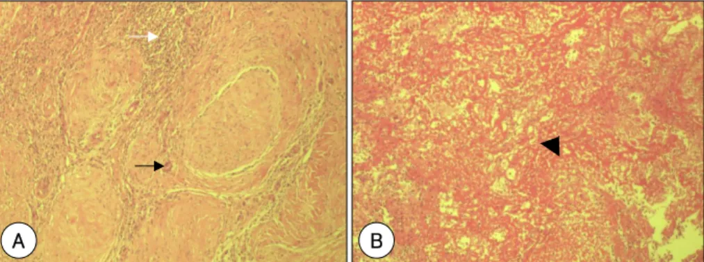 Fig. 3.  Representative histologic findings (Magnification×200) of right ventricular mass lesion in Behcet’s disease