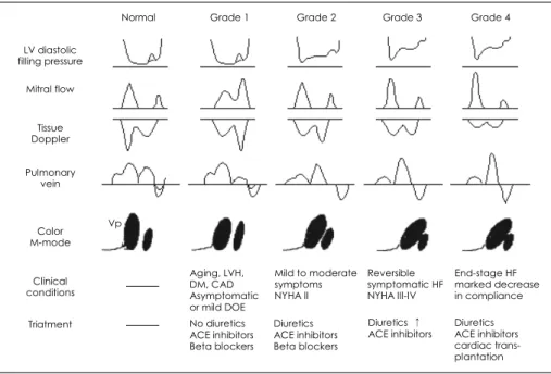 Fig. 3.  Diagram of a proposed grading system for diastolic dysfunction, as based on the progression of disease patterns in the patients with cardiac disease
