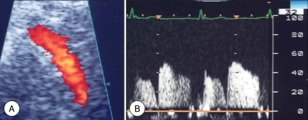 Fig. 1.  Demonstration of color (A) and pulsed Doppler (B) signals of coronary artery flow using TTE