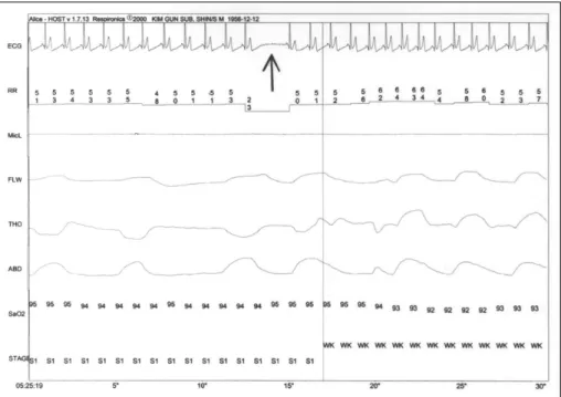 Fig. 2. One example of sinoatrial block on ECG indicated by an arrow. RR: R-R interval (HR), MicL: microphone, FLW: