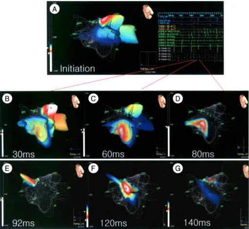 Fig. 2. Distribution of AF triggering APB foci. The most co- co-mmon foci were from RSPV and LSPV