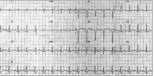 Fig. 1. The electrocardiogram showed sinus tachycardia, ST elevation and Q wave in the precordial leads from V 1  to V 3 