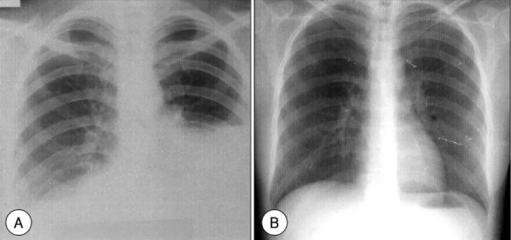 Fig. 1. A: chest X ray showed the massive bilateral pleural effusions (15 days after IVF)