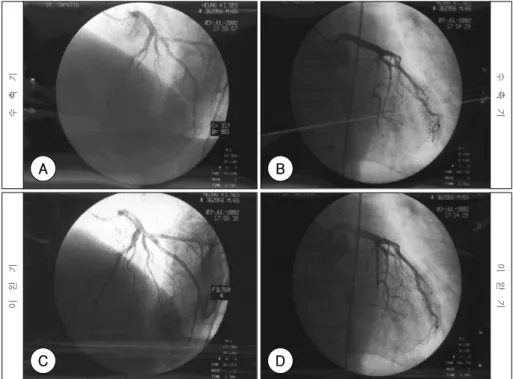 Fig. 1. EKG show atrial fibrillation with rapid ventricular res- res-ponse and elevation of ST segment in the V 2 -V 5 