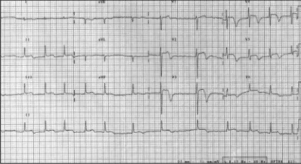 Fig. 4. Follow-up coronary angiogram show marked improved blood flow of LAD, but myocardial bridge is still noted at the previous portion