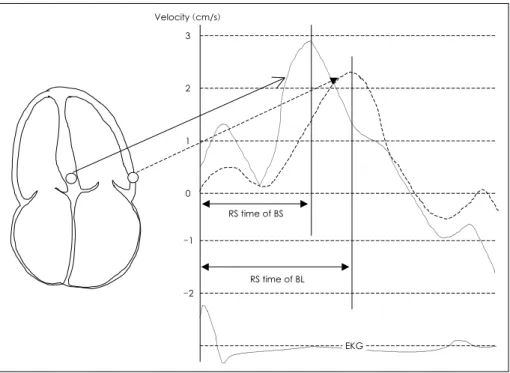 Fig. 1. The RS time was measured from the R-wave of the QRS complex to the peak systolic velocity and expressed in milliseconds