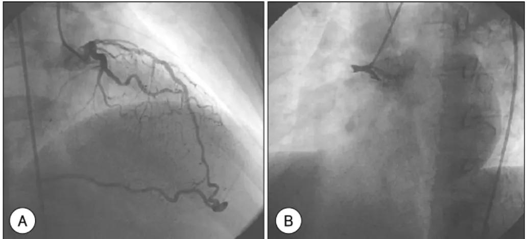 Fig. 1. Initial coronary angiography on 1 st  hospital day. There’s 24 mm long, 80% luminal narrowing in the mid left ante- ante-rior descending artery with thromby with collateral circulation to distal right coronary artery on LAO cranial projection (A)