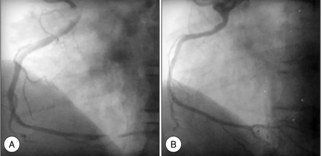 Fig. 1. An electrocardiogram showed atrial fibrillation, ST-segment elevations in the leads of V 3-6 , II, III and aVF, and ST segment depression in aVL and V1, 2 lead on arrival at the emergency room