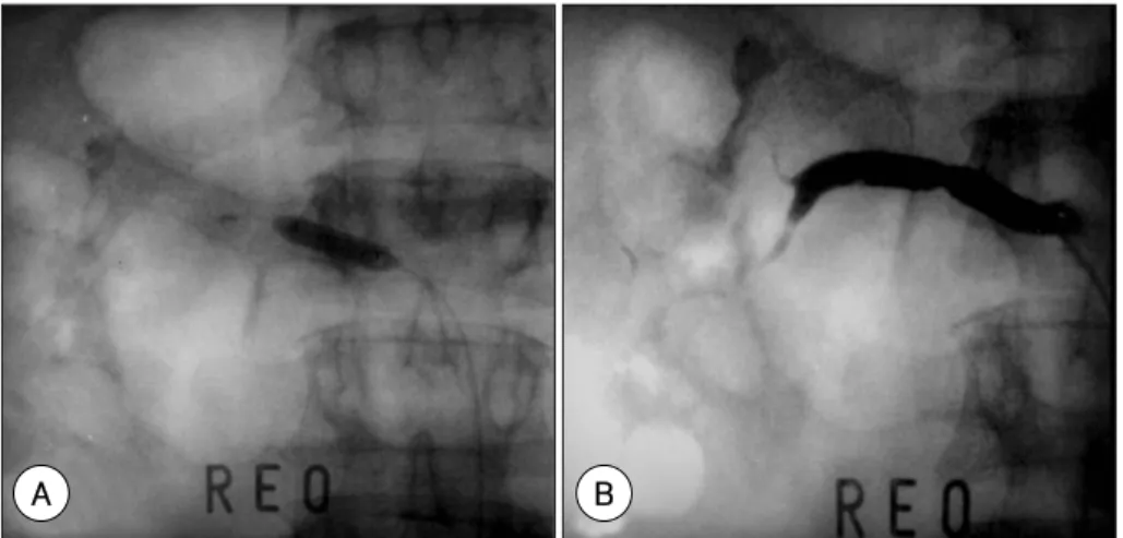 Fig. 4. A: percutaneous transluminal renal angioplasty (PTRA) using 6.0×20 mm balloon was performed