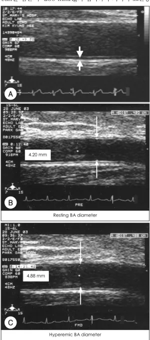Fig. 1. Measurement of intima media thickness (IMT) of common carotid artery (A) and flow mediated dilation ( FMD) of brachial artery