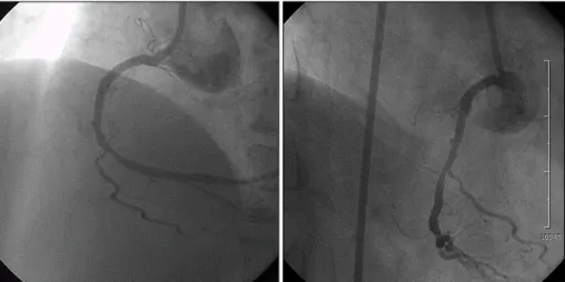 Fig. 3. After two stent grafts (3.0×16 mm JoStent GraftMaster ® , JoMed, Germany) placement, aneurysmal sac was closed successfully without significant residual stenosis