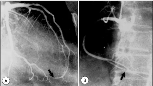 Fig. 5. Scanty cellular tumor with abundant amorphous extracellular matrix are attached to the endocardium by a broad base (A)
