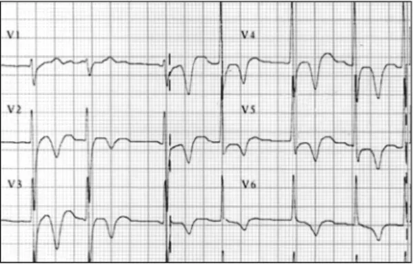 Fig. 1. ECG on presentation showing ST elevation in precordial leads V 2  to V 5  suggesting transmural  infarc-tion