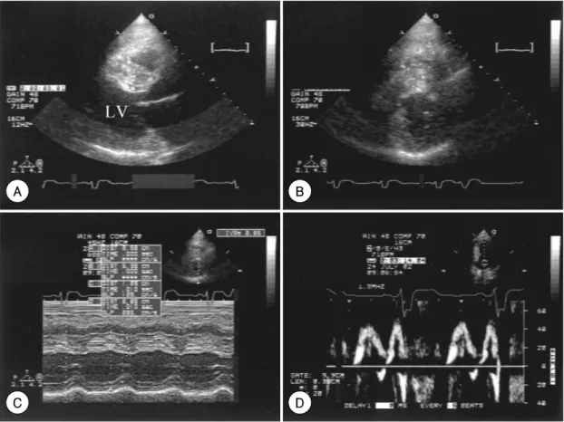 Fig. 1. A: 2-D echocardiogram at parasternal long axis view shows thickening of interventricular septum with granular sparkling appearance