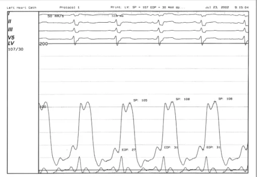 Fig. 2. Cardiac catheterization shows pressure equalization and dip and plateau configurations at diastole with high end diastolic pressure
