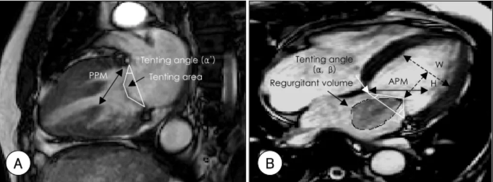 Fig. 1. Methods to measure the multiple geometric parameters (A), (B) and miral reguritant volume (B) in cardiac MRI