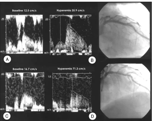 Figure 1. Baseline transthoracic Doppler (A) and coronary angiogram (B) results after the procedure, and follow up Doppler (C) and angiographic (D) results six months after the procedure, in a patient who had undergone stenting of the left anterior descend