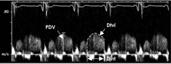 Figure 1. Parameters measured in the coronary flow velocity curve. The mean diastolic velocity (MDV) was calculated from Dtvi/Dint