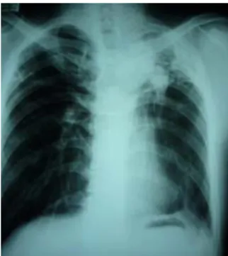 Fig.  1.  Chest  PA  by  X-ray  at  2008.7.28.