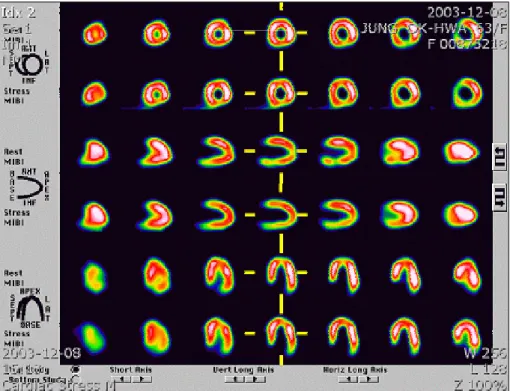 Figure 2. Myocardial SPECT-99mTc showing no perfusion defect in either the resting or stress phases
