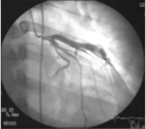 Figure 4. 60-degree left anterior oblique view with 25 de- de-grees cranial angulation of right coronary artery shows markedly dilated (maximal diameter of 10.0 mm) mid and distal portion and very sluggish antegrade flow