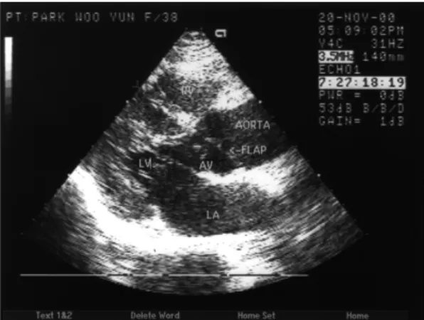 Fig. 4. Computerized tomography of the chest at the thoracic aorta level showed an intimal flap separate the lumen of the ascending and descending aorta