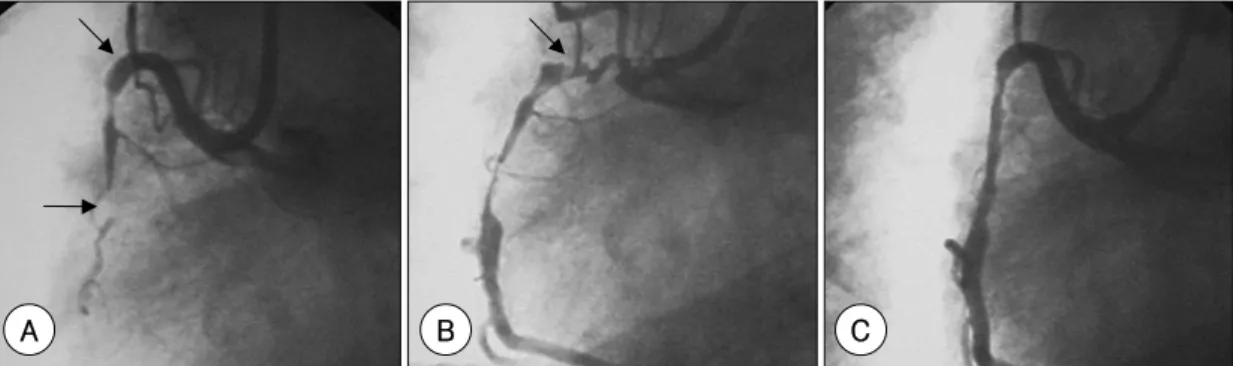 Fig. 1. A: diagnostic angiogram of the right coronary artery (RCA) prior to intervention