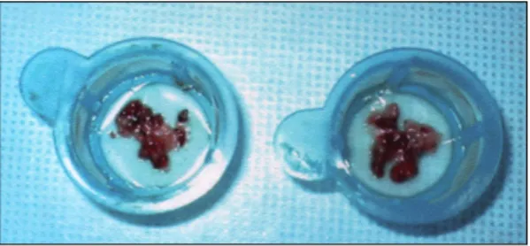 Fig. 6. Final peripheral angiography after procedure using PercuSurge GuardWire TM  System and 7 Fr